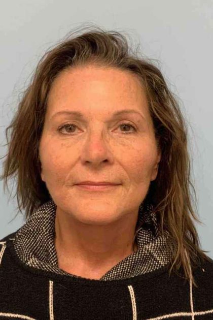 Facelift Before & After Patient #11450