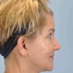Facelift Before & After Patient #11457