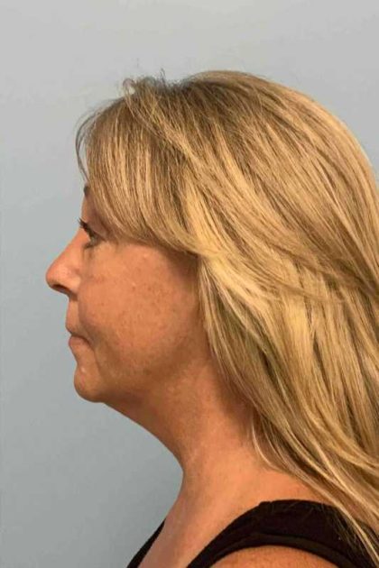 Eyelid Surgery Before & After Patient #11464