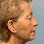 Eyelid Surgery Before & After Patient #11476