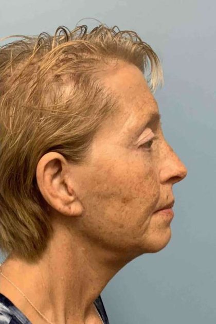Eyelid Surgery Before & After Patient #11476