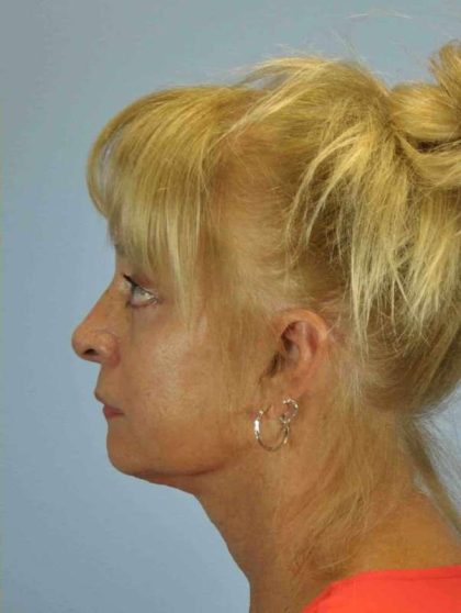 Eyelid Surgery Before & After Patient #11490