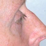 Eyelid Surgery Before & After Patient #11497