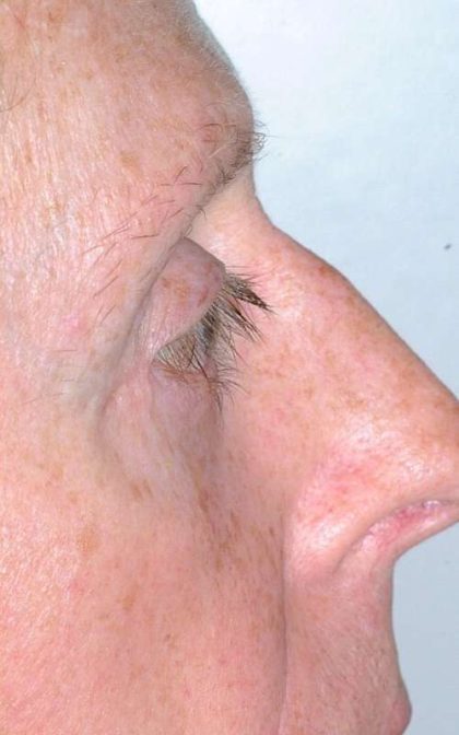 Eyelid Surgery Before & After Patient #11497