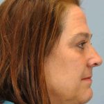 Eyelid Surgery Before & After Patient #11504