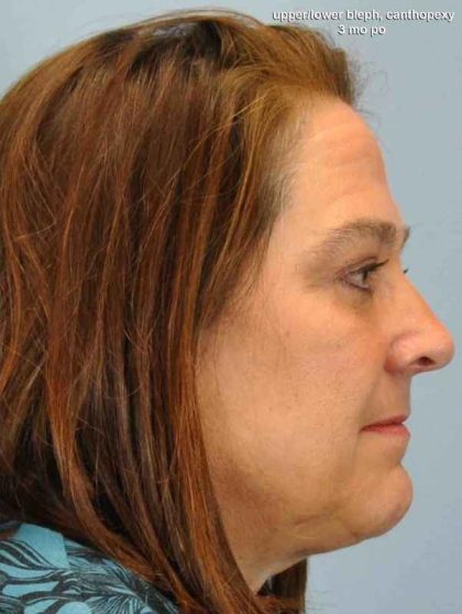 Eyelid Surgery Before & After Patient #11504