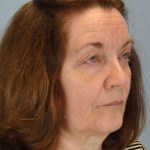 Eyelid Surgery Before & After Patient #11518