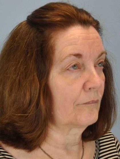 Eyelid Surgery Before & After Patient #11518