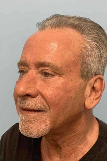 Eyelid Surgery Before & After Patient #11525