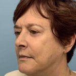Eyelid Surgery Before & After Patient #11532