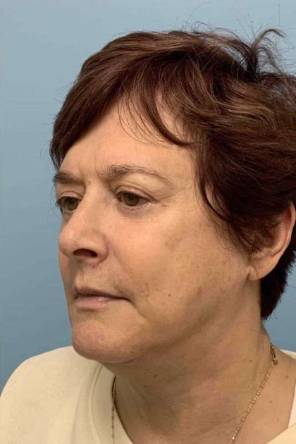 Eyelid Surgery Before & After Patient #11532