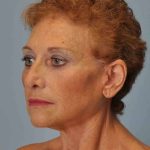 Eyelid Surgery Before & After Patient #11558