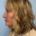 Eyelid Surgery Before & After Patient #11572