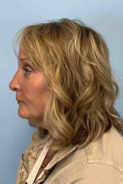 Eyelid Surgery Before & After Patient #11572