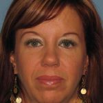 Eyelid Surgery Before & After Patient #11648