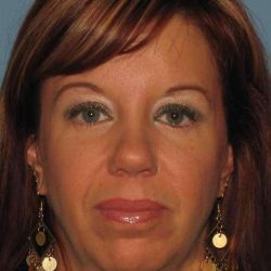 Eyelid Surgery Before & After Patient #11648