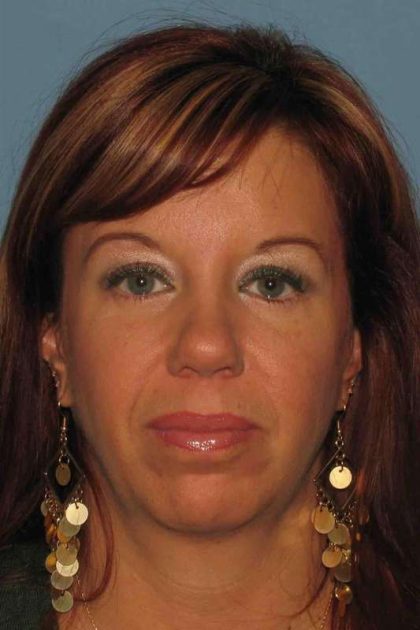 Eyelid Surgery Before & After Patient #11648