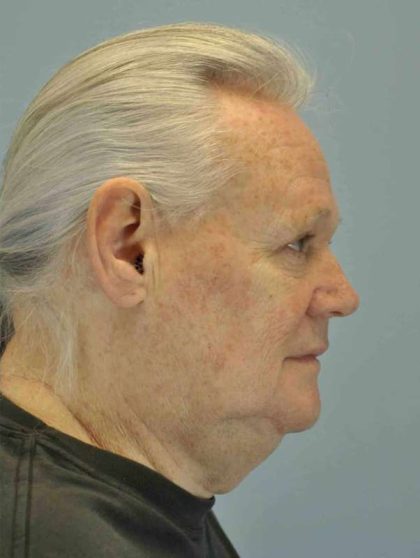 Eyelid Surgery Before & After Patient #11655