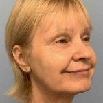 Eyelid Surgery Before & After Patient #11668