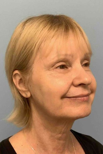 Eyelid Surgery Before & After Patient #11668