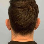 Ear Surgery Before & After Patient #11680