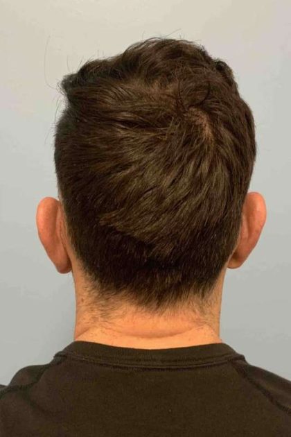 Ear Surgery Before & After Patient #11680