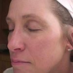 Chemical Peels Before & After Patient #11701