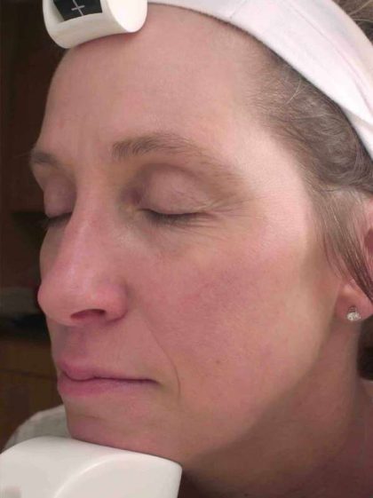 Chemical Peels Before & After Patient #11701