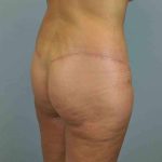 Buttocks Before & After Patient #11718