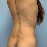 Buttocks Before & After Patient #11728