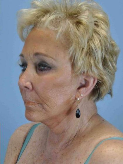 Brow Lift Before & After Patient #11742
