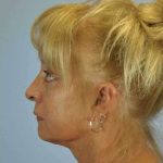 Brow Lift Before & After Patient #11756