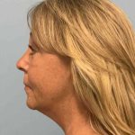 Brow Lift Before & After Patient #11770