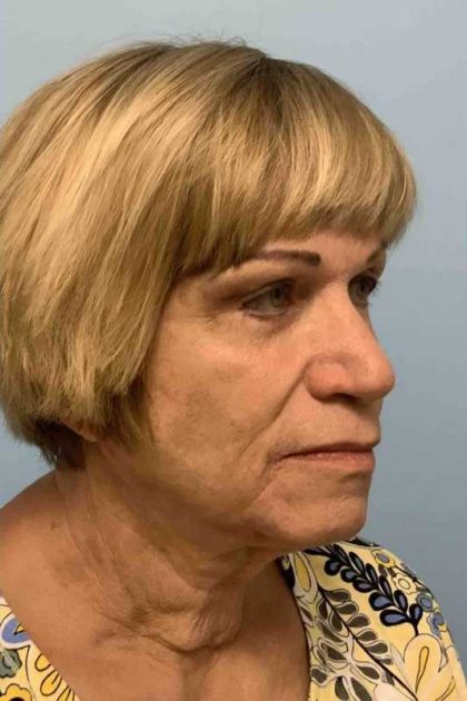 Brow Lift Before & After Patient #11779