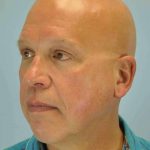 Brow Lift Before & After Patient #11824