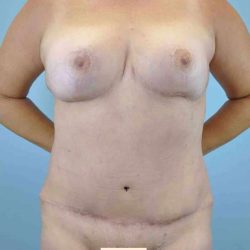 Breast Reduction Before & After Patient #11829
