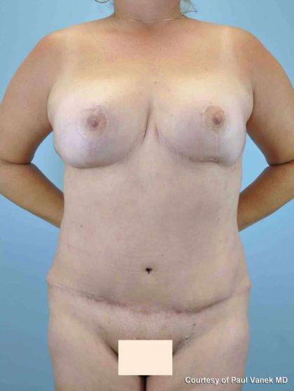 Breast Reduction Before & After Patient #11829