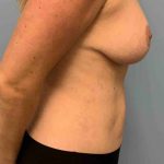 Breast Reduction Before & After Patient #11847
