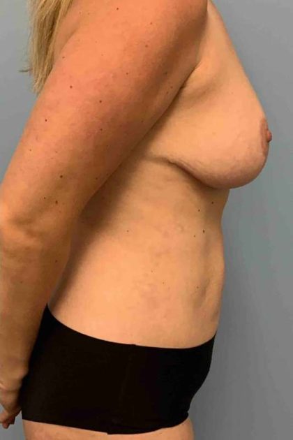 Breast Reduction Before & After Patient #11847