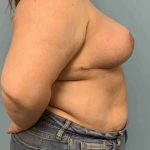 Breast Reduction Before & After Patient #11854
