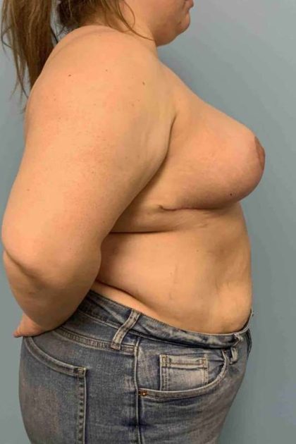 Breast Reduction Before & After Patient #11854