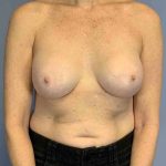 Breast Reconstruction Before & After Patient #11884