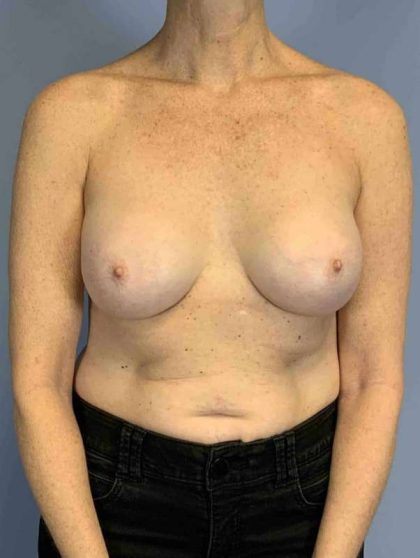 Breast Reconstruction Before & After Patient #11884
