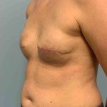 Breast Reconstruction Before & After Patient #11894