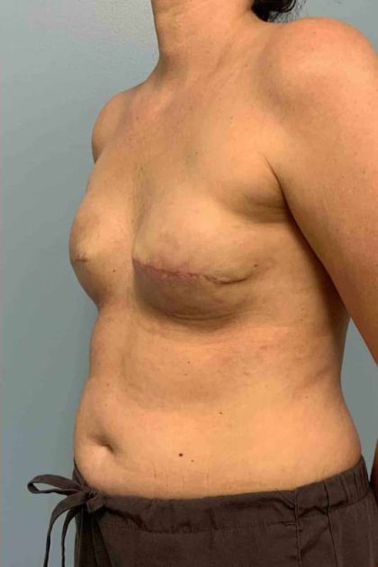 Breast Reconstruction Before & After Patient #11894