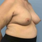 Breast Reconstruction Before & After Patient #11901
