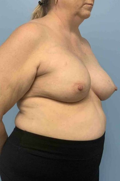 Breast Reconstruction Before & After Patient #11901
