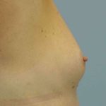 Breast Reconstruction Before & After Patient #11908