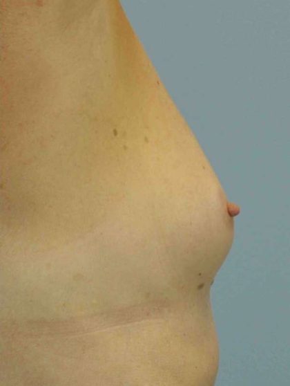 Breast Reconstruction Before & After Patient #11908