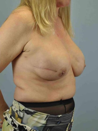 Breast Reconstruction Before & After Patient #11919
